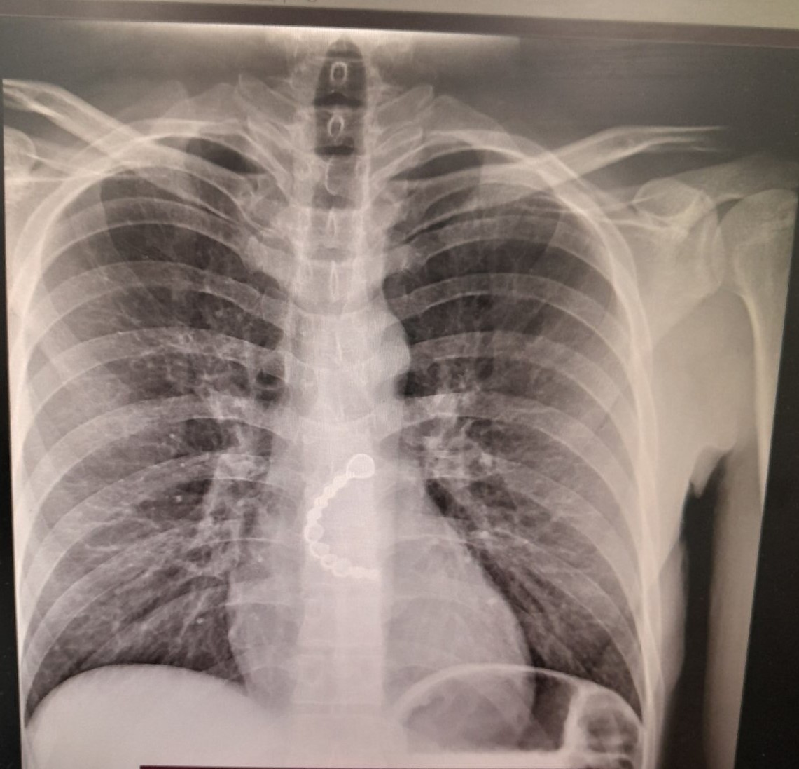 Gëlltiti dhëmbët, 35-vjeçari përfundon në QKUK