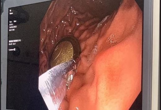 4-vjeçari përpinë monedhën, dërgohet në QKUK