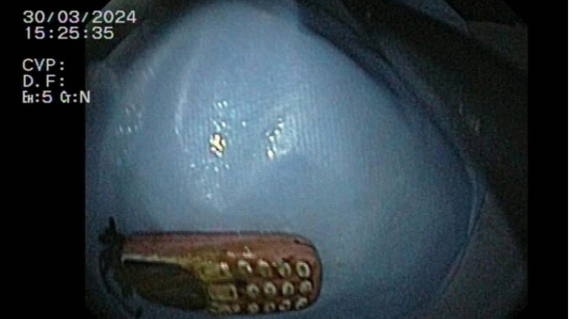 Malishevë: Pacientit i largohet telefoni nga stomaku