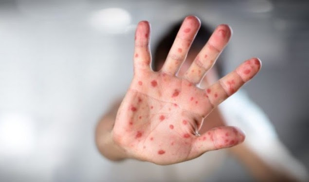 Për një javë raportohen 9 raste të fruthit në Kosovë, IKSHPK: Më të rrezikuarit fëmijët e pavaksinuar